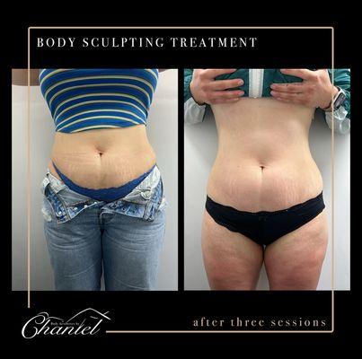 Ultrasound cavitation along with radio frequency and laser lipo- Body Sculpting package.