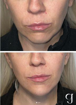 Having a well balanced chin can dramatically enhance facial balancing.