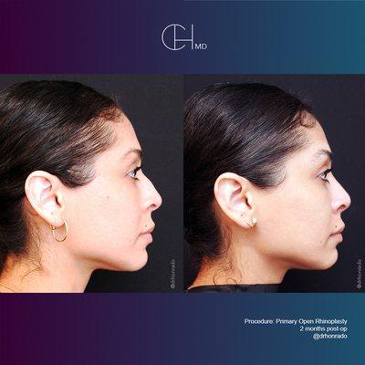 Carlo Honrado, M.D., F.A.C.S. Primary Rhinoplasty 2 months post-op