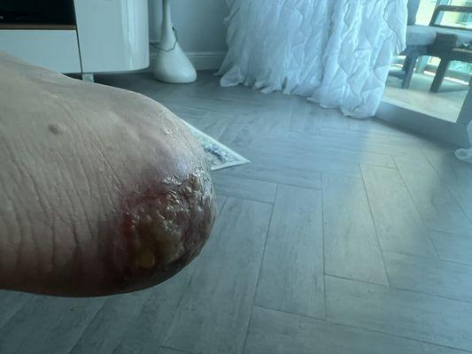 My foot after getting caught on a treadmill during exercise due to lack of space in their studio