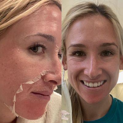 Amazing results from our VI Peel