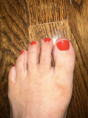 Crooked toe nail cut.