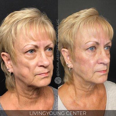 Cheeks & Mid-face filler