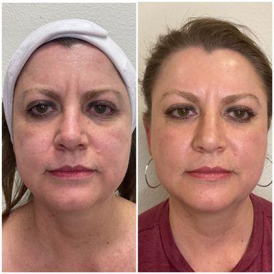 Facelift with HIFU therapy-one treatment