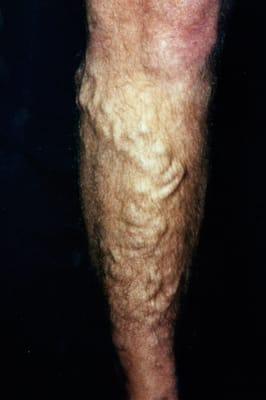 varicose veins before therapy