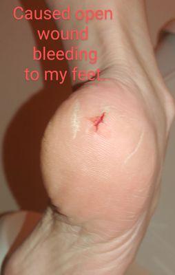 Caused open sore, bleeding to my heel.