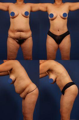 Tummy Tuck with Liposuction