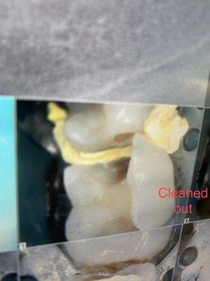 Conserving as much as the tooth as possible, We prepared the tooth for an onlay instead of a crown.