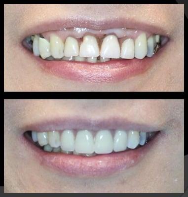 Full mouth rehabilitation.  Upper and lower.  Smile lines restored and perfected.  See how lip line now follows the incisal line. Beautiful!