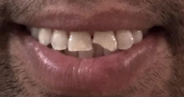 Chipped Tooth