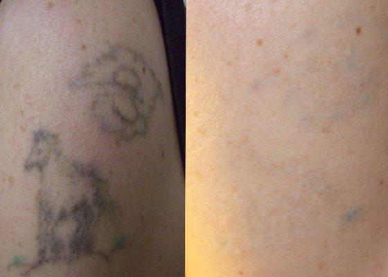 Laser tattoo removal, 6 sessions @ CPMedSpa Laser & Skin. Text a pic of your tatt to 910-347-5444 for a per session price.