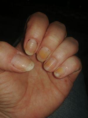 Yellow nails from fungal infection