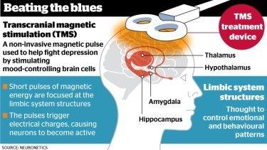 TMS can help with depression  when antidepressants cant.