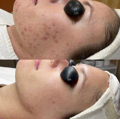 Acne Specialists of Oakland