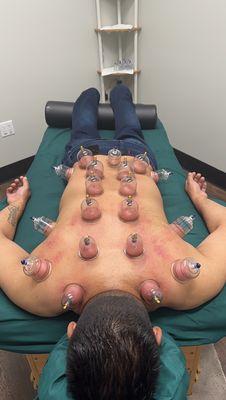 Cupping boosts blood flow to the area, easing muscle tension and promoting cell repair and tissue growth.