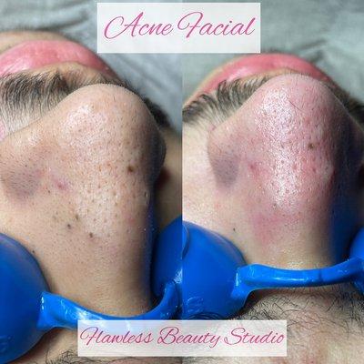 Acne facial