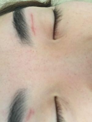 scars after eyebrow wax