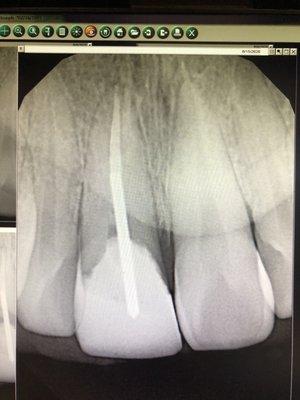 After root canal treatment