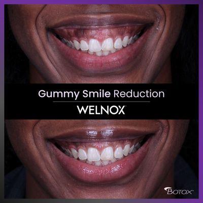 Gummy Smile Reduction