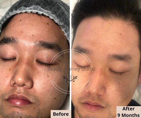 Remove scars without surgery 9 months.