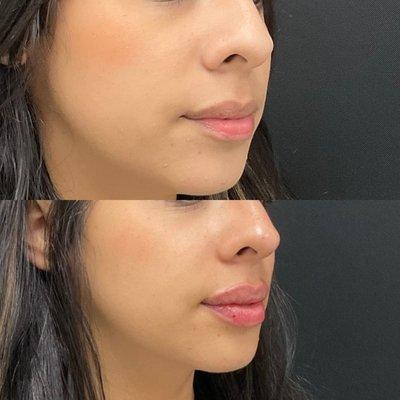 1 Syringe of HA Lip FIller before and after.