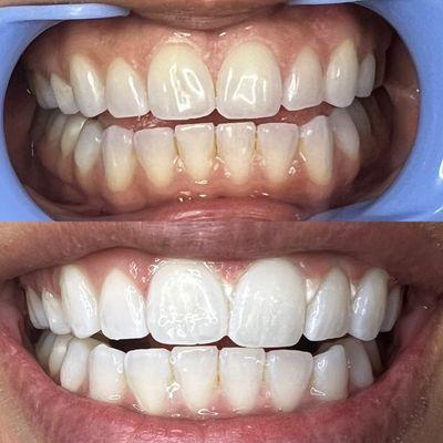 Teeth whitening client