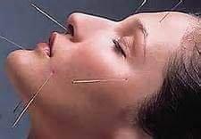 Facial Acupuncture to stimulate collagen.