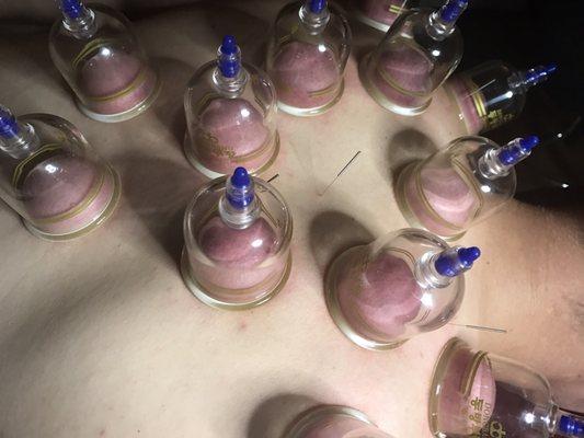 Cupping and acupuncture