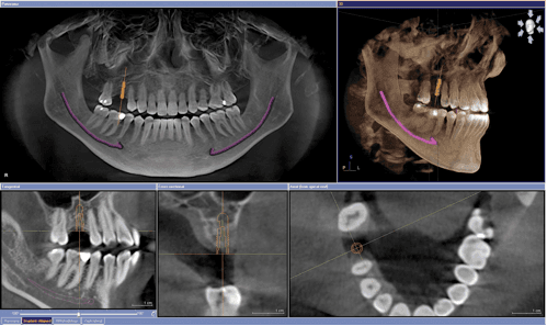 3-D CAT SCAN