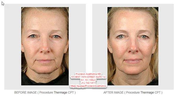 Thermage   before after https://sites.google.com/view/thermage-ny/more-thermage