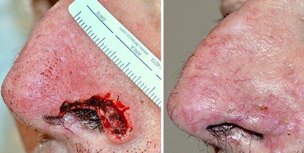 Neglected skin cancer eaten through the nostril, cured with Mohs surgery and reconstructed under local anesthesia with a skin flap.