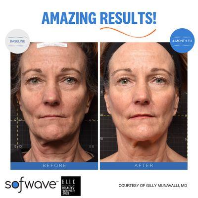 non surgical face lift with SOFWAVE