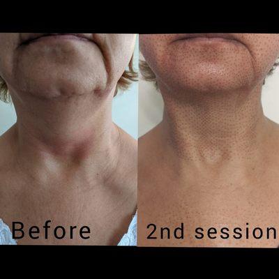 NECK! CHIN! LIPS! look at that amazing change so crazy!! Drop that filler/botox appt and look at this alternative Fibroblast treatment.