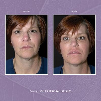 Filler Perioral Lip Lines Before & After