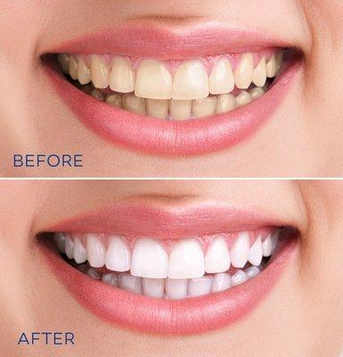 teeth whitening