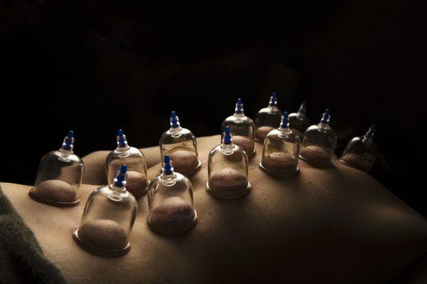 Cupping reduces pain, stress, tension and increases athletic performance.