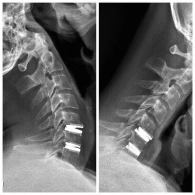 Motion preserving cervical disc replacements for cervical radiculopathy