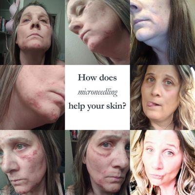 Microneedling healing process and results!