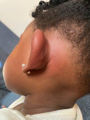 Reaction bite to her ear.