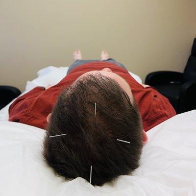 Scalp Acupuncture for TBI