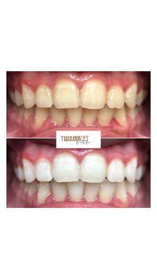 Teeth whitening before & after