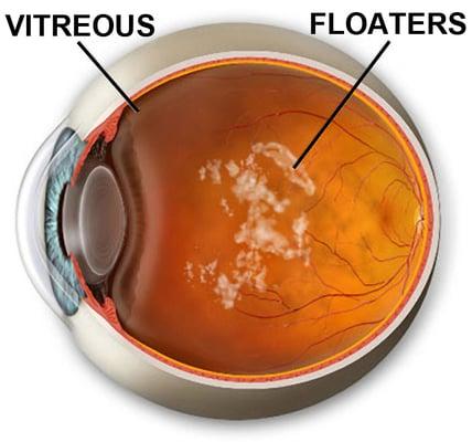 Eye Floaters are protein densities in the vitreous fluid of the eye. Patients see them as moving shadows in their vision.