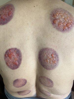 Mother received cupping here and was badly injured.