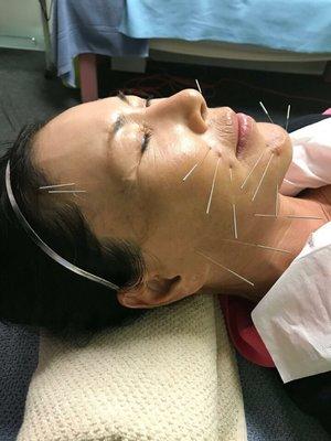 facial acupuncture