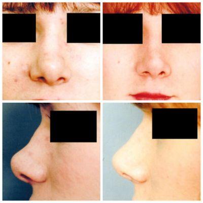 25-34 year old woman treated with Rhinoplasty (Nose Surgery)