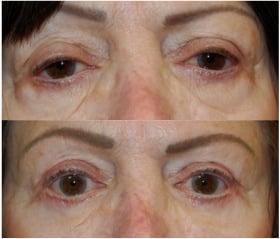 upper and lower eyelid blepharoplasty and ptosis repair