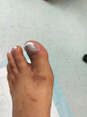 The infection in my toe