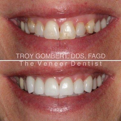 Before and after shot of my front teeth getting veneers.