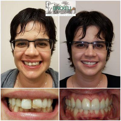 Natural looking crowns & Veneers