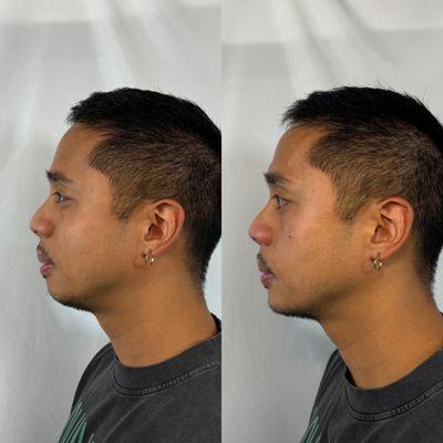 Pre and Post Chin Filler done by Nurse Kristine.